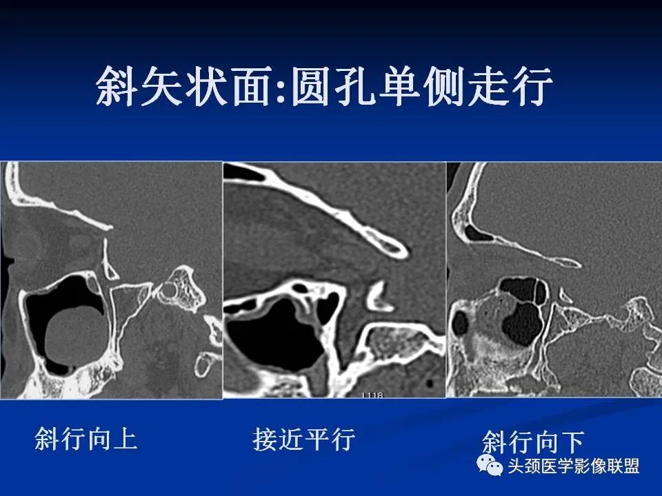 影像PPT - 【PPT】变应性真菌性鼻窦炎的影像表现-54