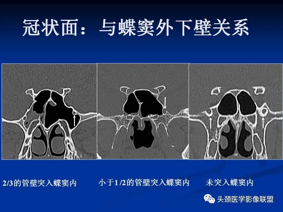 影像PPT - 【PPT】变应性真菌性鼻窦炎的影像表现-56