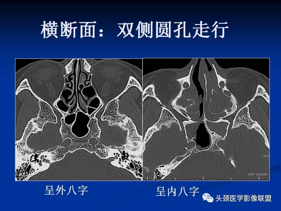 影像PPT - 【PPT】变应性真菌性鼻窦炎的影像表现-55
