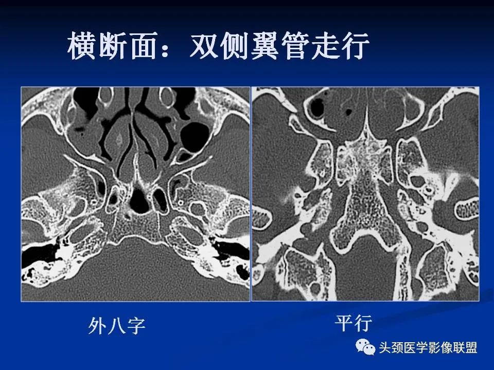 影像PPT - 【PPT】变应性真菌性鼻窦炎的影像表现-59