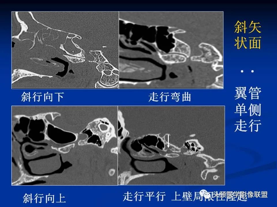 影像PPT - 【PPT】变应性真菌性鼻窦炎的影像表现-58