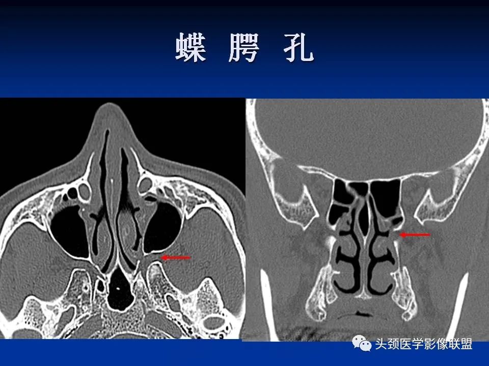 影像PPT - 【PPT】变应性真菌性鼻窦炎的影像表现-62