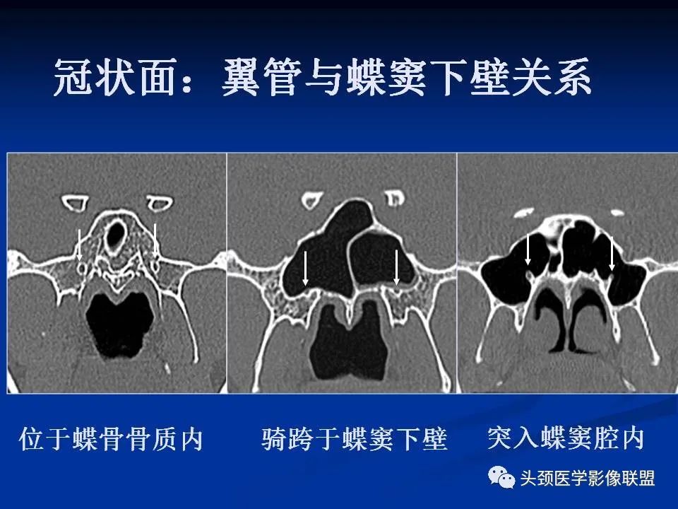 影像PPT - 【PPT】变应性真菌性鼻窦炎的影像表现-60