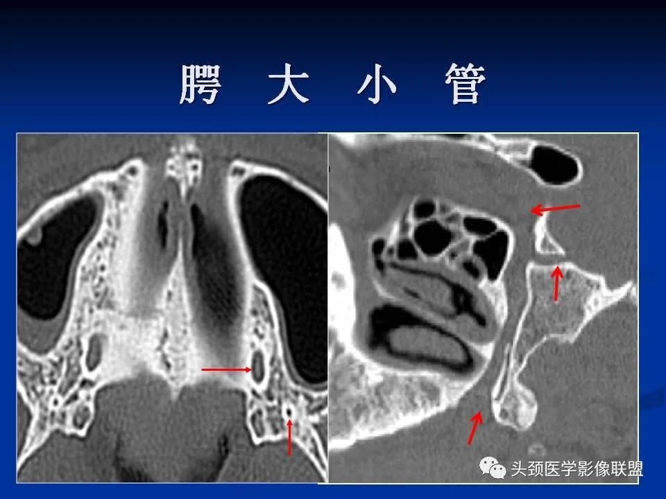 影像PPT - 【PPT】变应性真菌性鼻窦炎的影像表现-63