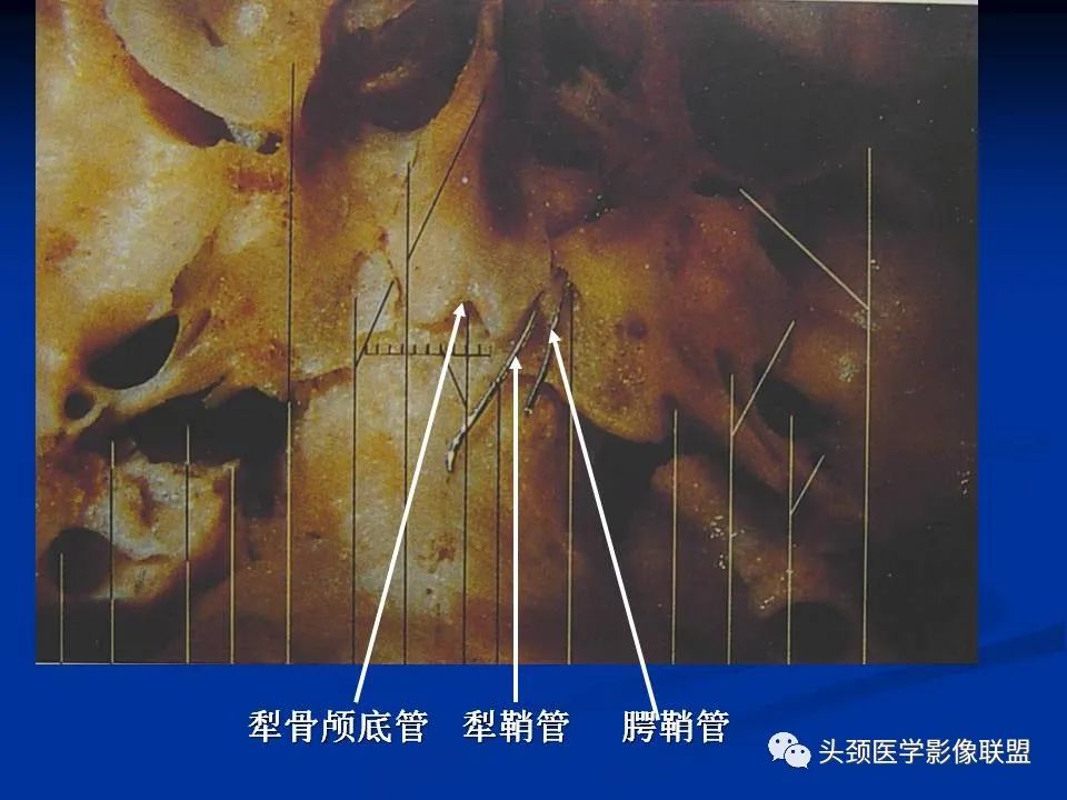 影像PPT - 【PPT】变应性真菌性鼻窦炎的影像表现-65