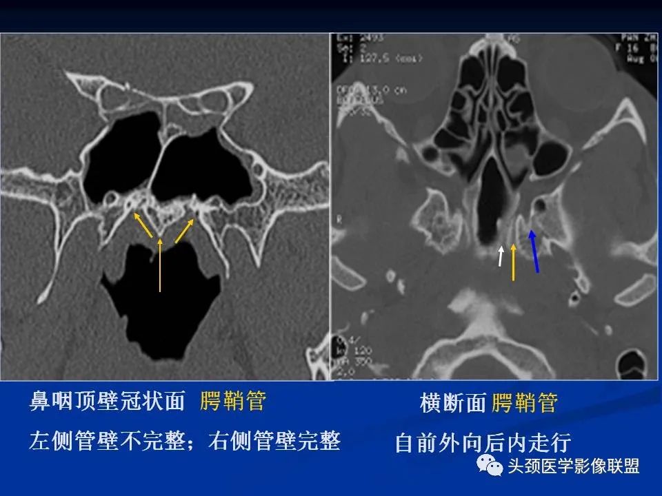 影像PPT - 【PPT】变应性真菌性鼻窦炎的影像表现-67