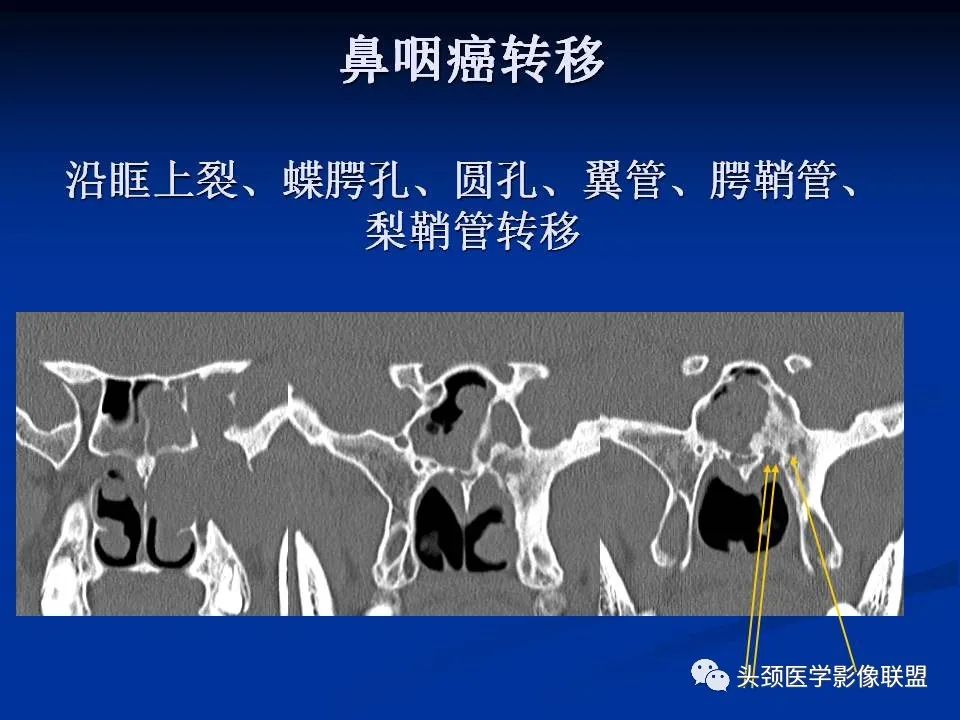 影像PPT - 【PPT】变应性真菌性鼻窦炎的影像表现-72