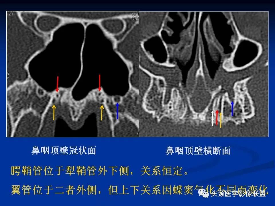 影像PPT - 【PPT】变应性真菌性鼻窦炎的影像表现-70