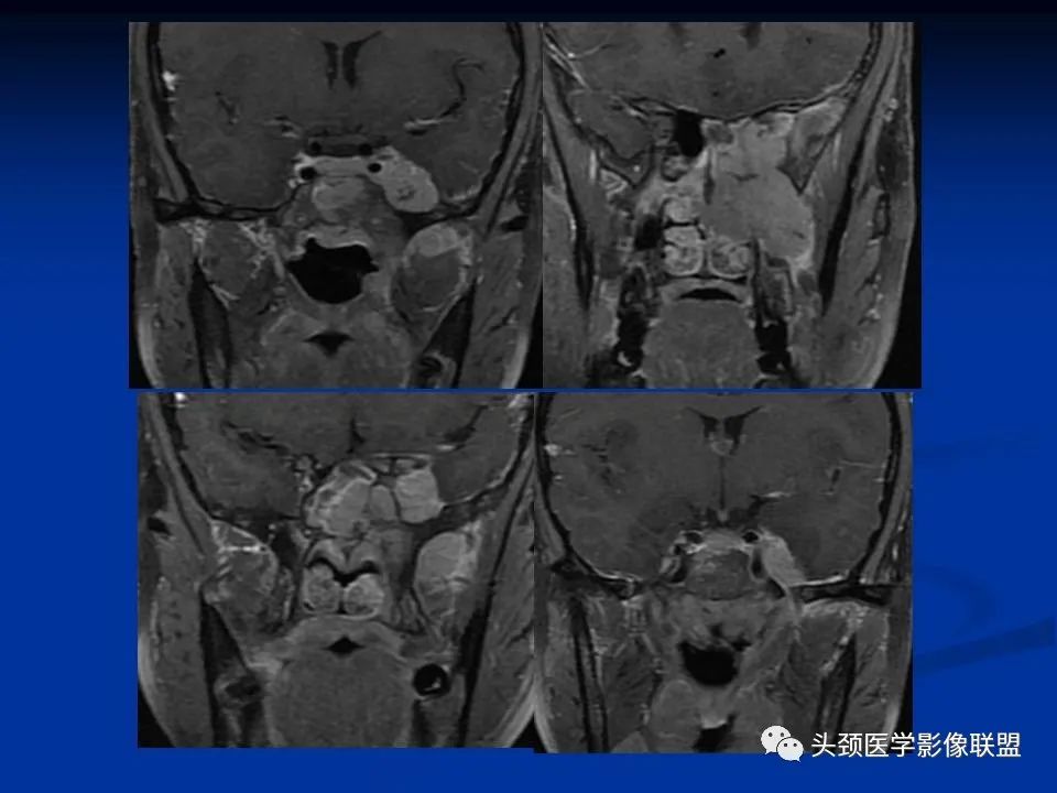 影像PPT - 【PPT】变应性真菌性鼻窦炎的影像表现-74