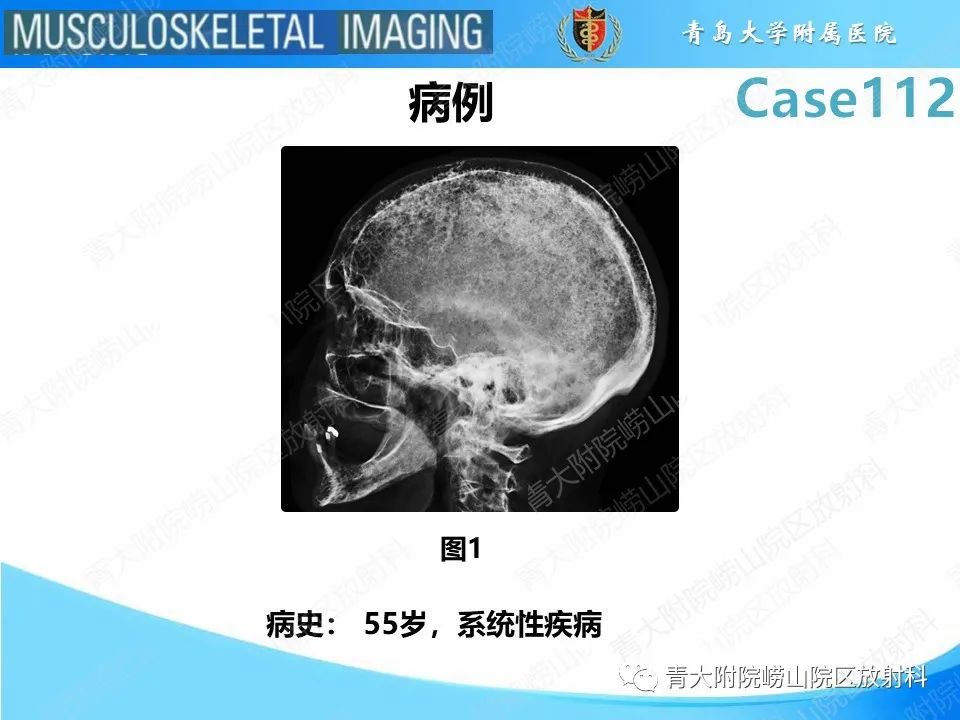 影像PPT - 【PPT】多发性骨髓瘤：颅骨-2