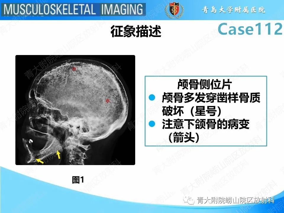 影像PPT - 【PPT】多发性骨髓瘤：颅骨-11
