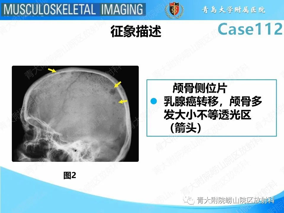 影像PPT - 【PPT】多发性骨髓瘤：颅骨-12