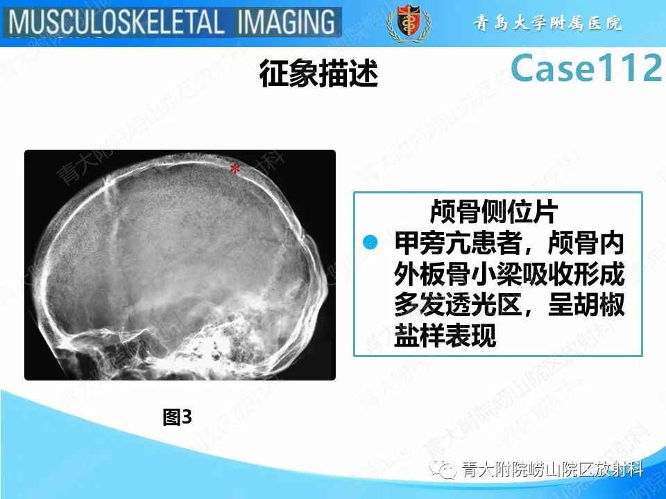 影像PPT - 【PPT】多发性骨髓瘤：颅骨-13