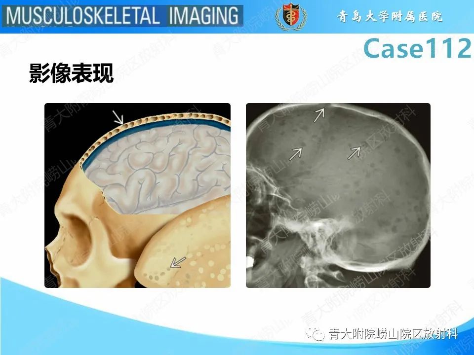 影像PPT - 【PPT】多发性骨髓瘤：颅骨-16