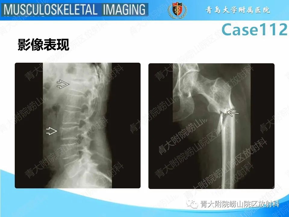 影像PPT - 【PPT】多发性骨髓瘤：颅骨-17