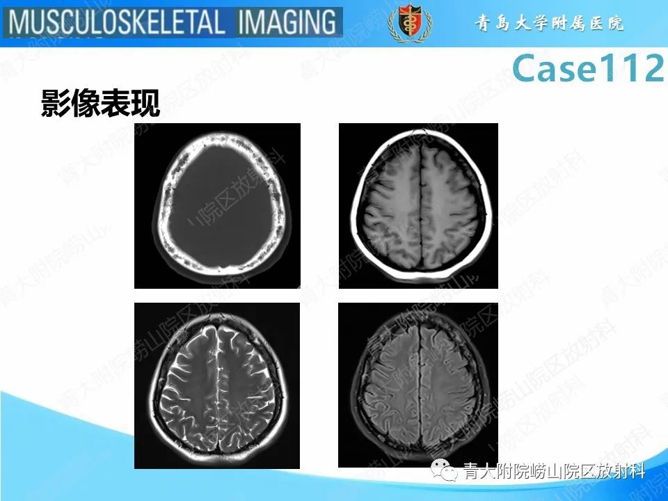 影像PPT - 【PPT】多发性骨髓瘤：颅骨-18