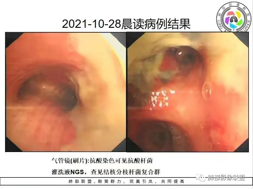 影像PPT - 【病例】结核继发气管支气管淀粉变-40 影像PPT - 【病例】结核继发气管支气管淀粉变-40