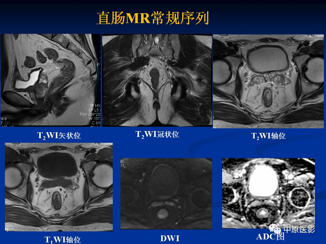 影像PPT - 【PPT】直肠癌的MRI诊断-5
