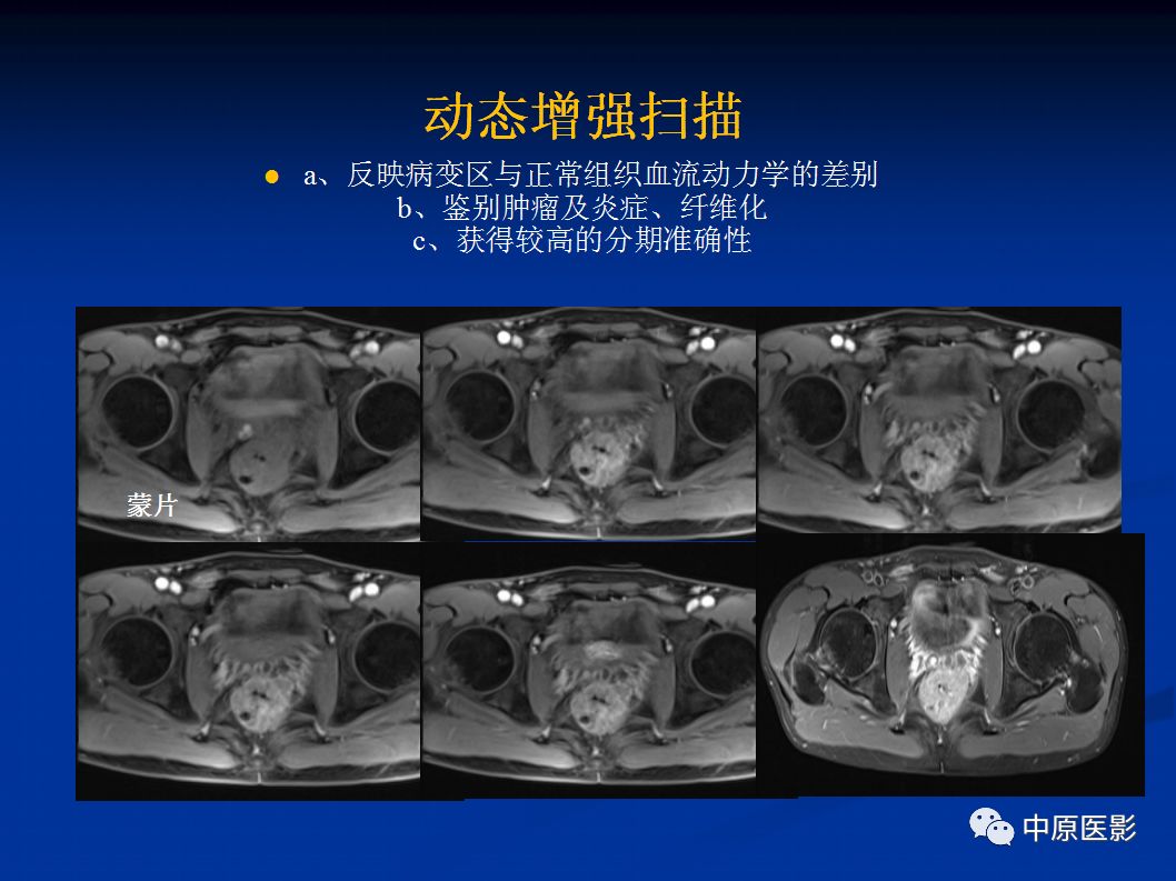 影像PPT - 【PPT】直肠癌的MRI诊断-6