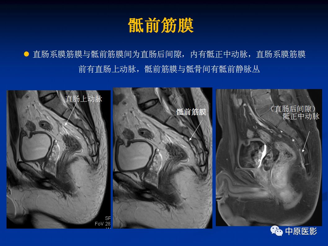 影像PPT - 【PPT】直肠癌的MRI诊断-12