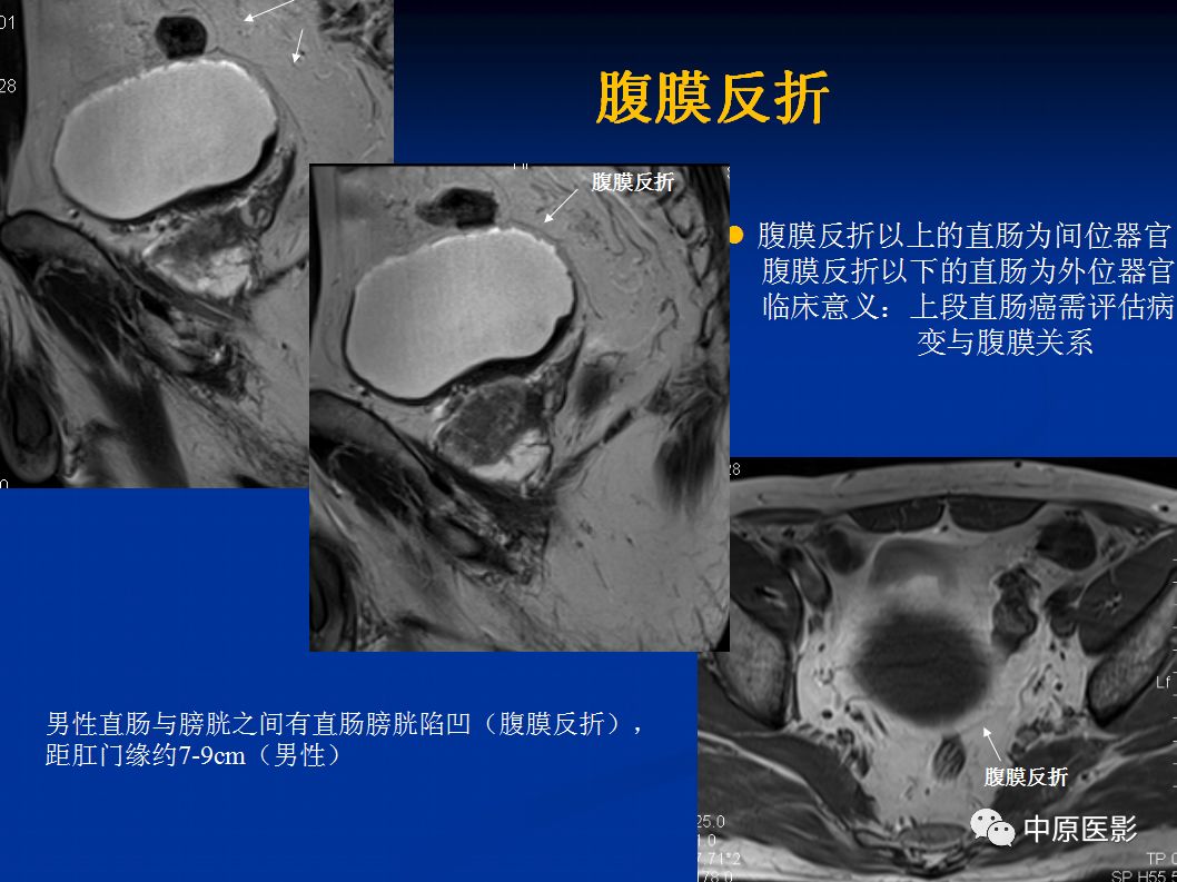 影像PPT - 【PPT】直肠癌的MRI诊断-10
