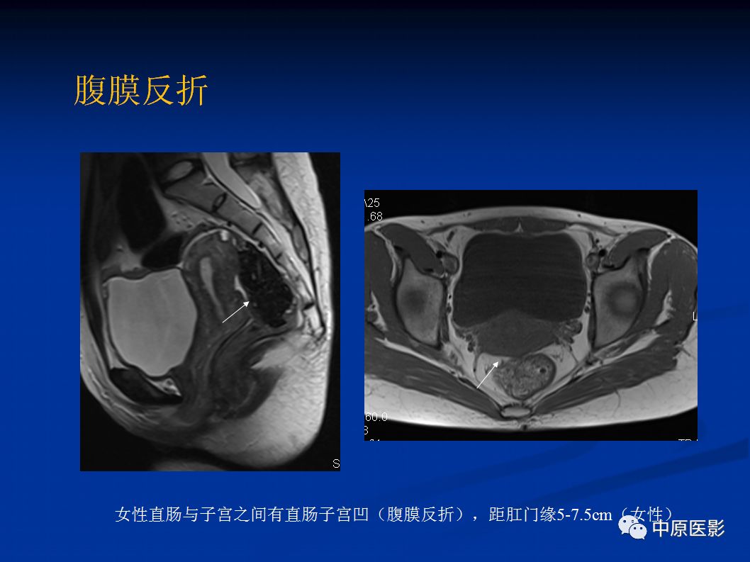 影像PPT - 【PPT】直肠癌的MRI诊断-11