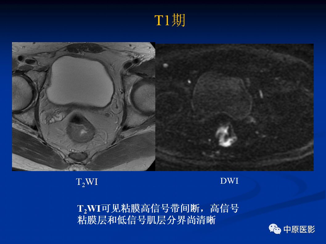 影像PPT - 【PPT】直肠癌的MRI诊断-18