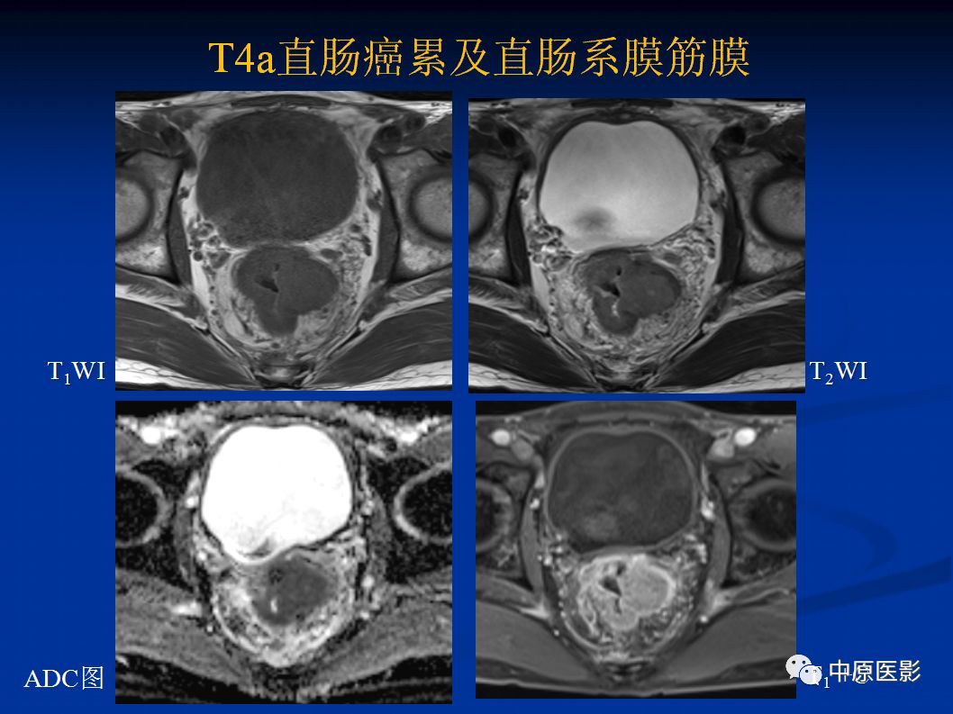 影像PPT - 【PPT】直肠癌的MRI诊断-25