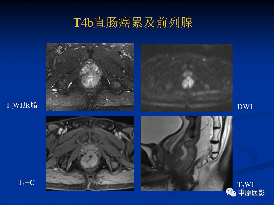 影像PPT - 【PPT】直肠癌的MRI诊断-26