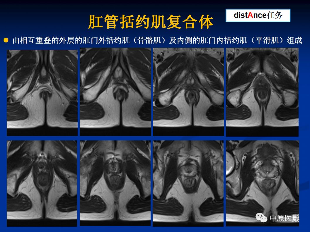 影像PPT - 【PPT】直肠癌的MRI诊断-28