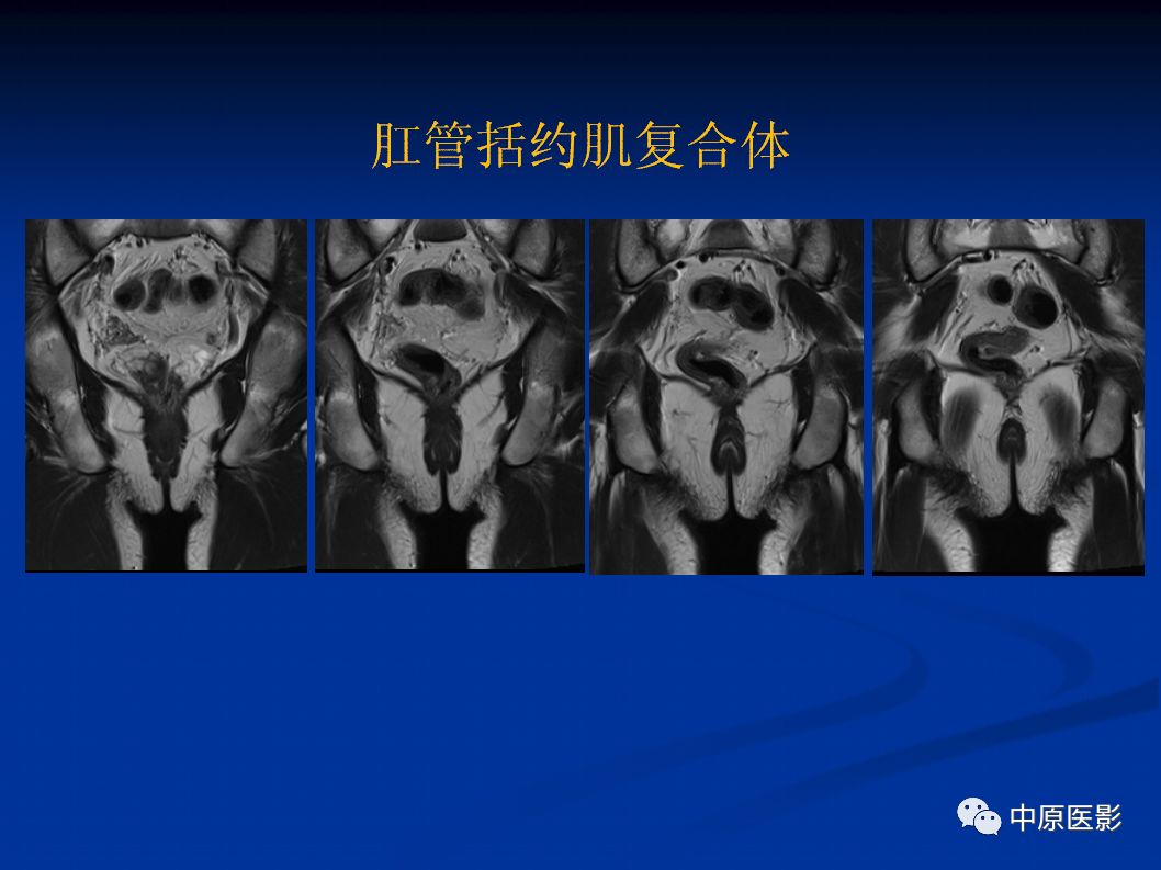 影像PPT - 【PPT】直肠癌的MRI诊断-29