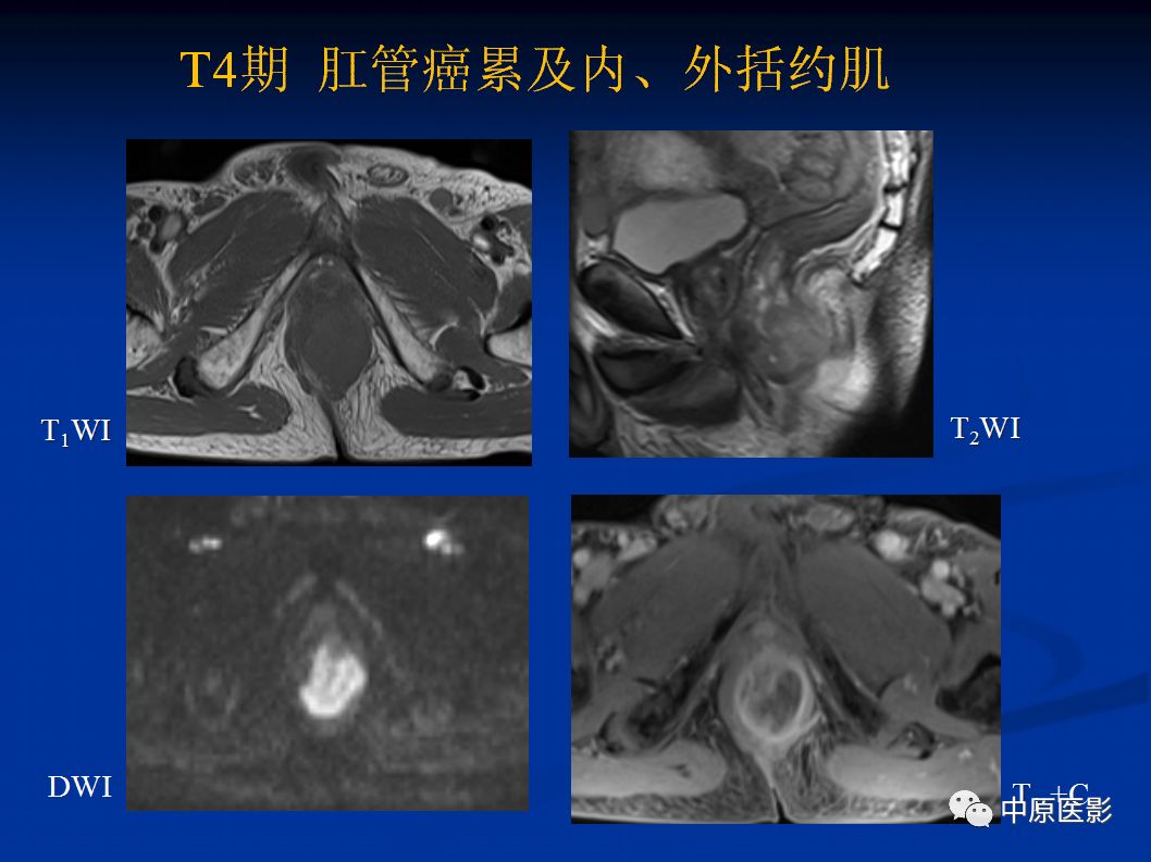 影像PPT - 【PPT】直肠癌的MRI诊断-33