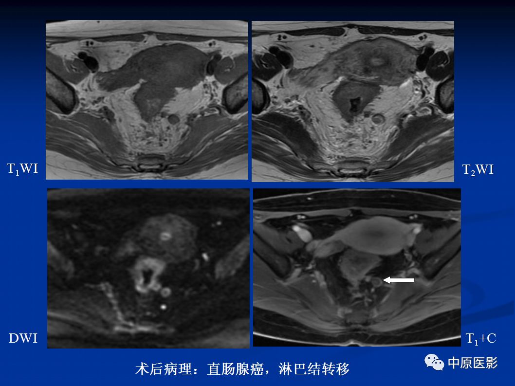 影像PPT - 【PPT】直肠癌的MRI诊断-36