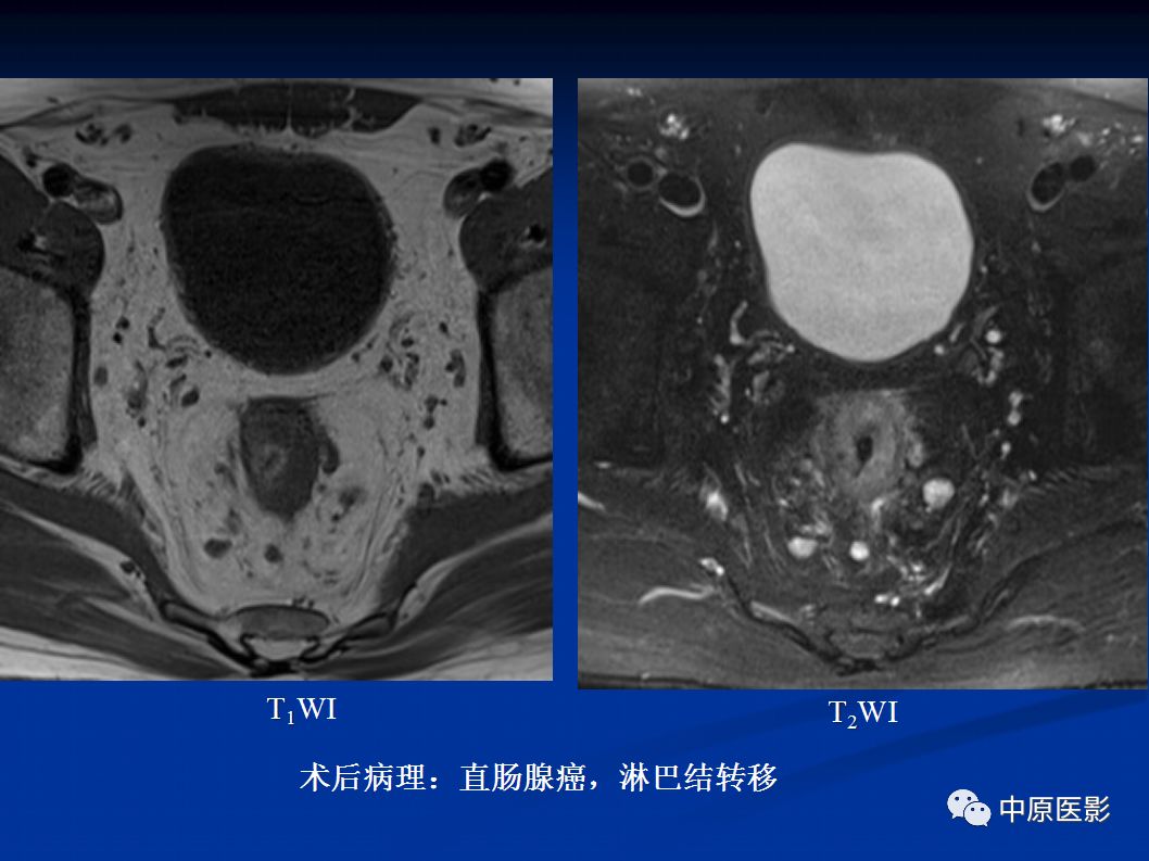 影像PPT - 【PPT】直肠癌的MRI诊断-37