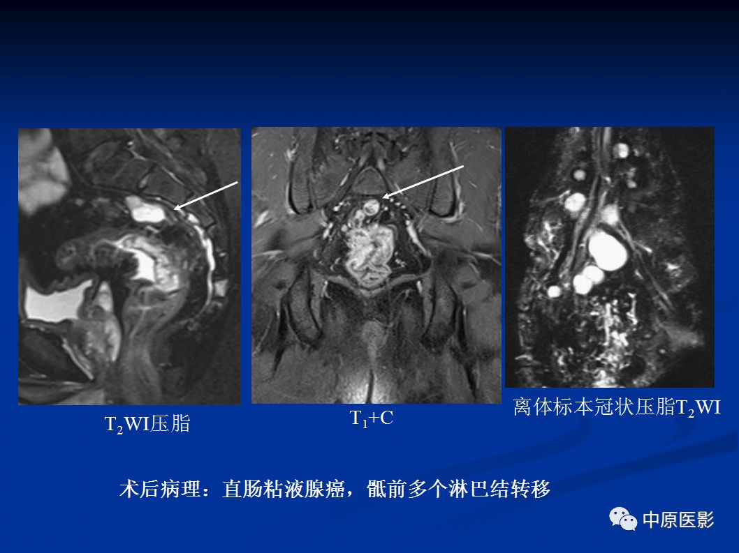 影像PPT - 【PPT】直肠癌的MRI诊断-38