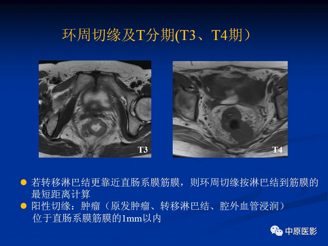 影像PPT - 【PPT】直肠癌的MRI诊断-40