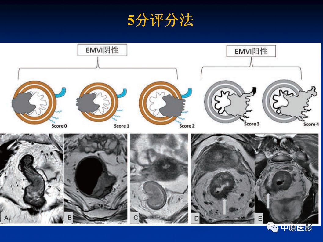 影像PPT - 【PPT】直肠癌的MRI诊断-42