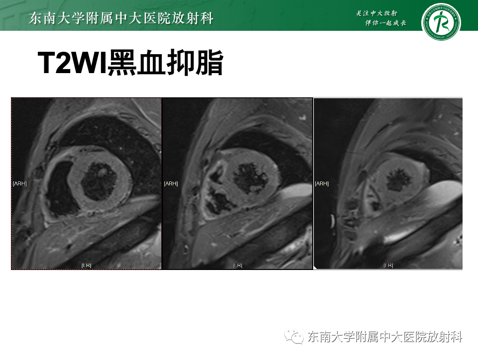 影像PPT - 【病例】法布雷病4例MR-14 影像PPT - 【病例】法布雷病4例MR-14