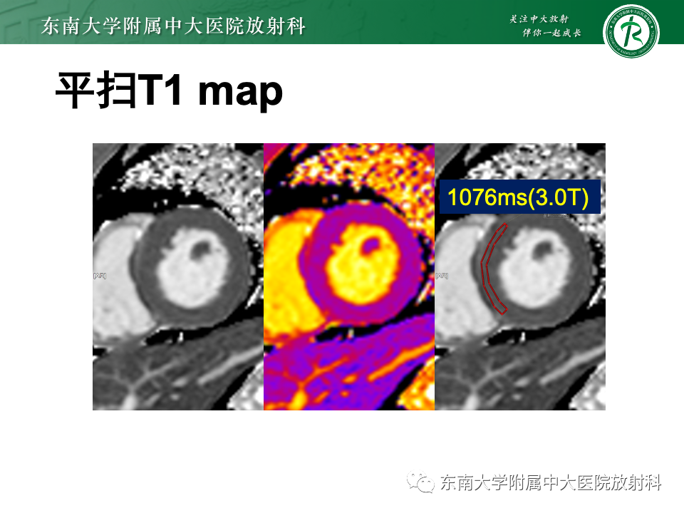 影像PPT - 【病例】法布雷病4例MR-15 影像PPT - 【病例】法布雷病4例MR-15
