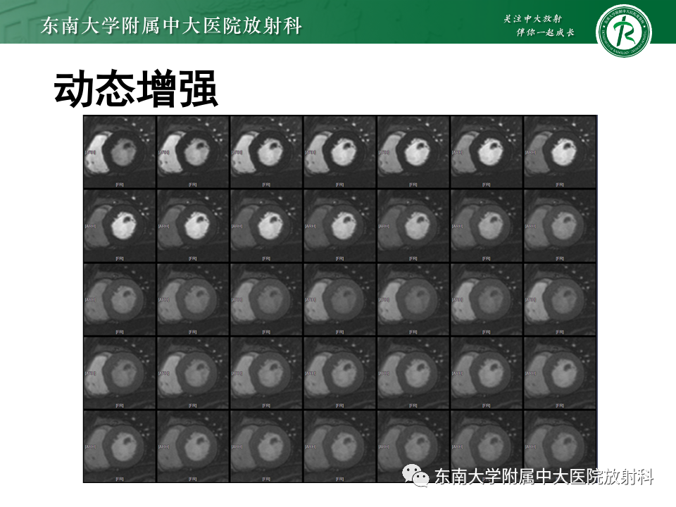 影像PPT - 【病例】法布雷病4例MR-16 影像PPT - 【病例】法布雷病4例MR-16