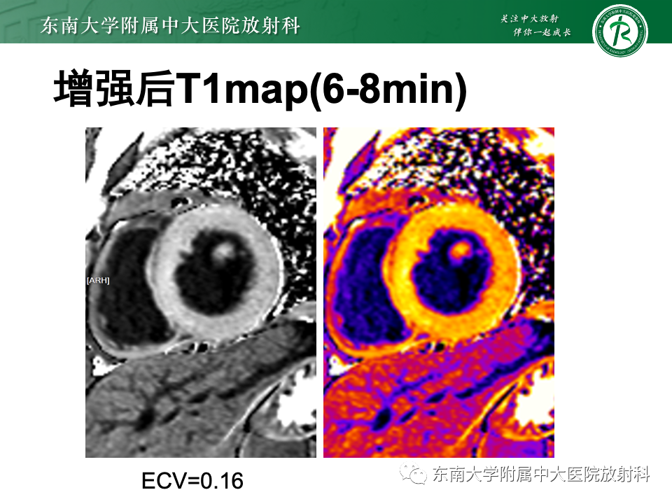 影像PPT - 【病例】法布雷病4例MR-17 影像PPT - 【病例】法布雷病4例MR-17