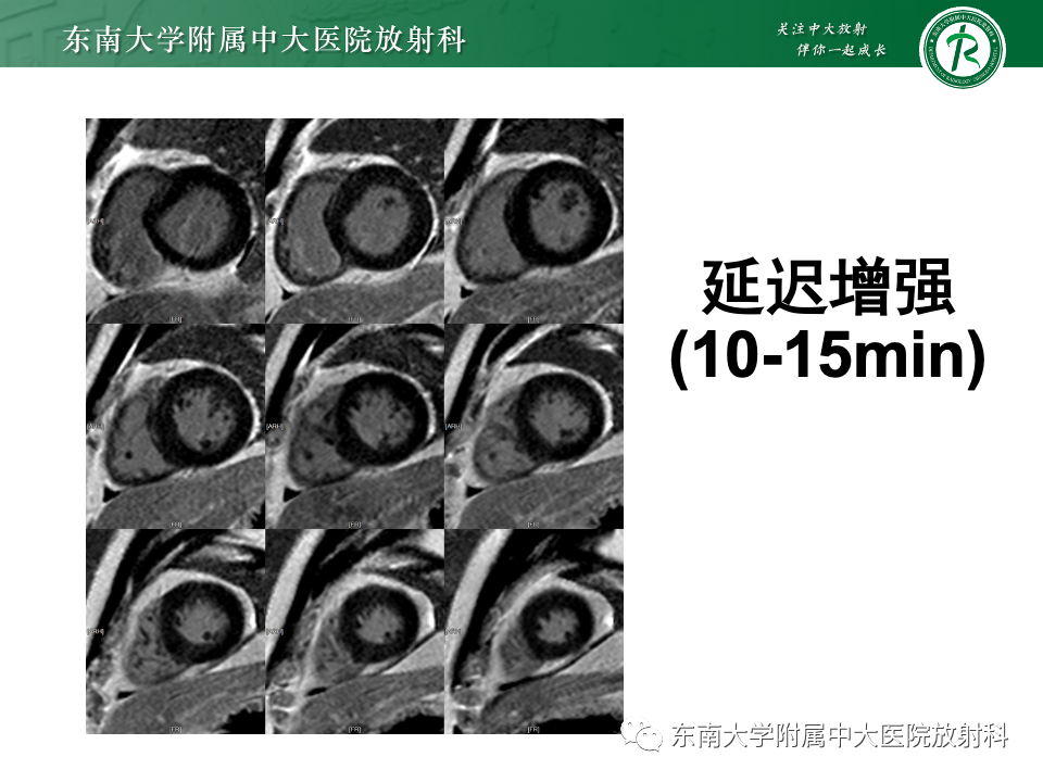影像PPT - 【病例】法布雷病4例MR-18 影像PPT - 【病例】法布雷病4例MR-18