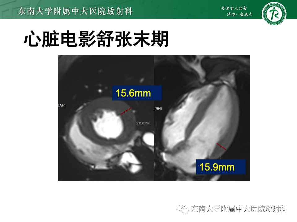 影像PPT - 【病例】法布雷病4例MR-21 影像PPT - 【病例】法布雷病4例MR-21