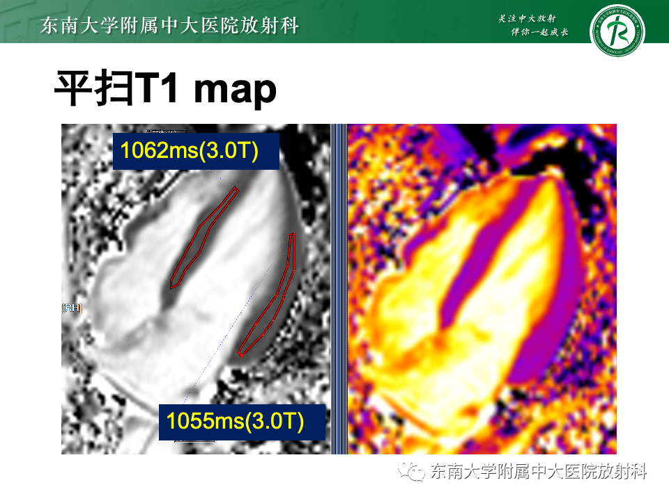 影像PPT - 【病例】法布雷病4例MR-22 影像PPT - 【病例】法布雷病4例MR-22