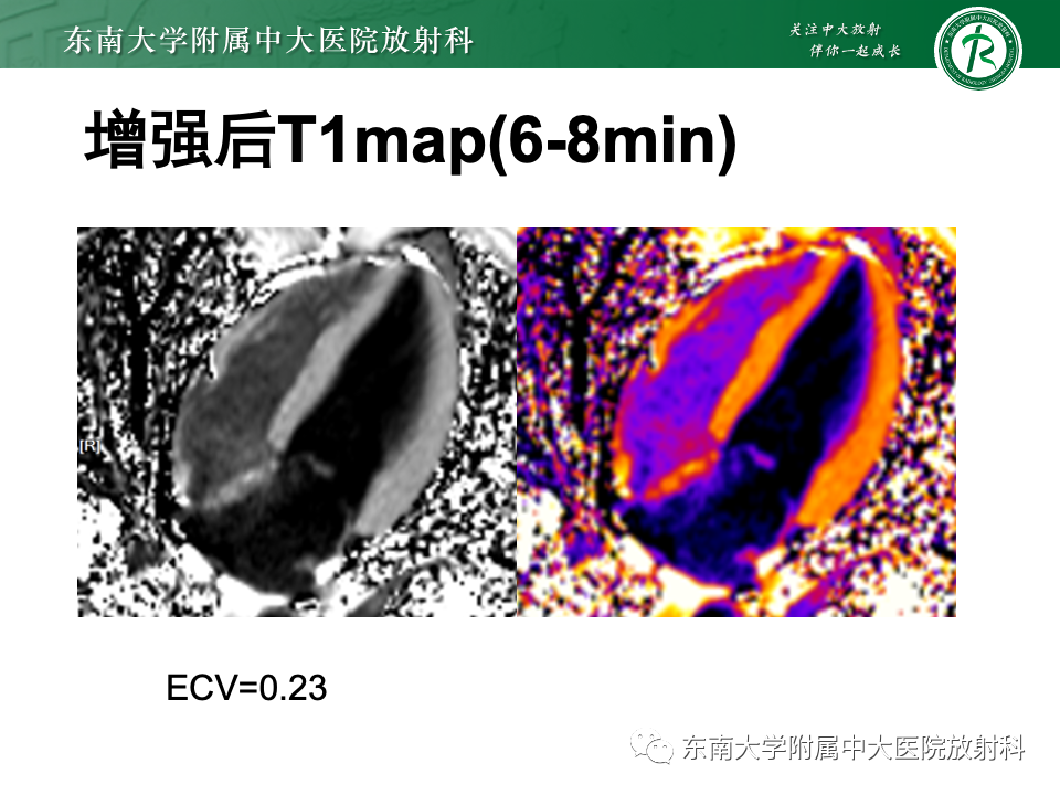 影像PPT - 【病例】法布雷病4例MR-24 影像PPT - 【病例】法布雷病4例MR-24