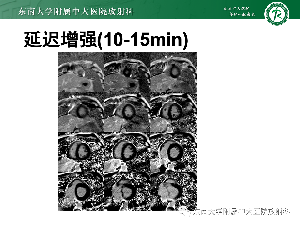 影像PPT - 【病例】法布雷病4例MR-25 影像PPT - 【病例】法布雷病4例MR-25