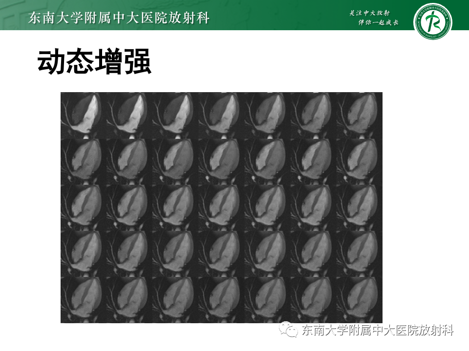影像PPT - 【病例】法布雷病4例MR-23 影像PPT - 【病例】法布雷病4例MR-23