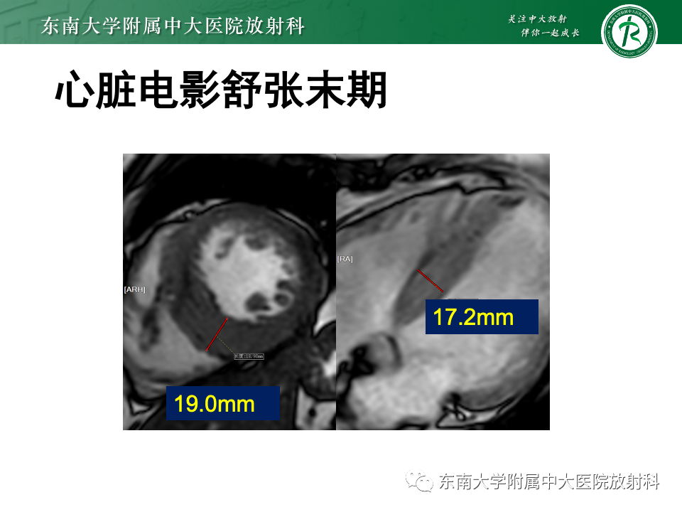 影像PPT - 【病例】法布雷病4例MR-28 影像PPT - 【病例】法布雷病4例MR-28