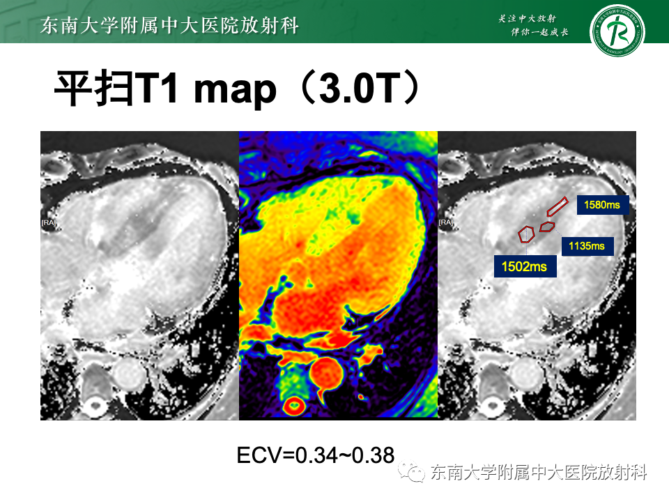 影像PPT - 【病例】法布雷病4例MR-29 影像PPT - 【病例】法布雷病4例MR-29