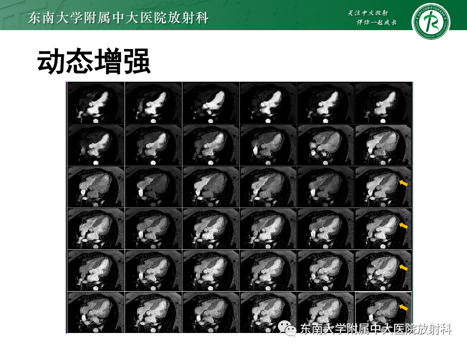 影像PPT - 【病例】法布雷病4例MR-30 影像PPT - 【病例】法布雷病4例MR-30